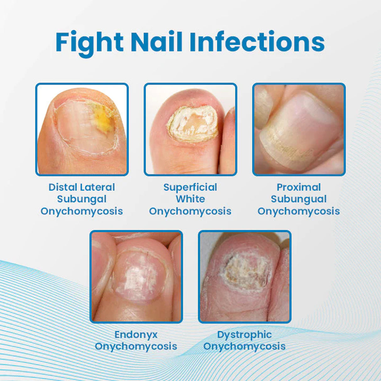 Anti-Paronychia Nail Repairing Gel, Repair Encased Rotten Nails Soft Nails Thickening Pain Relief Cleansing Care - V.I.P Digital Presence