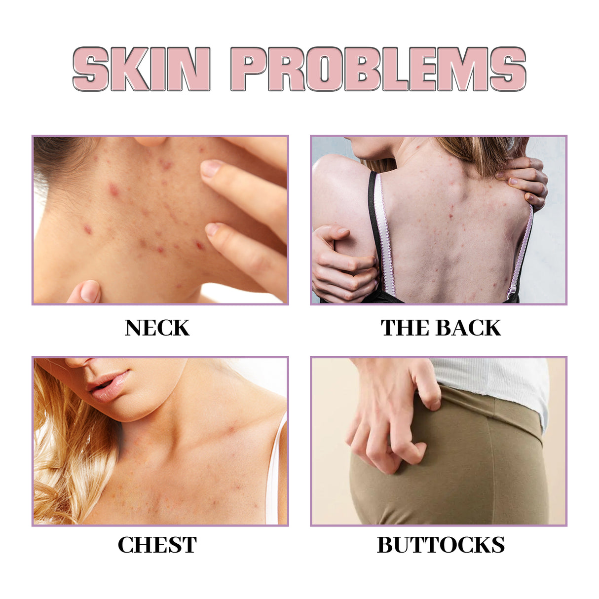 Acne Acne Ball, And Cleansing Skin Chest Back Acne Closing Skin Care - V.I.P Digital Presence