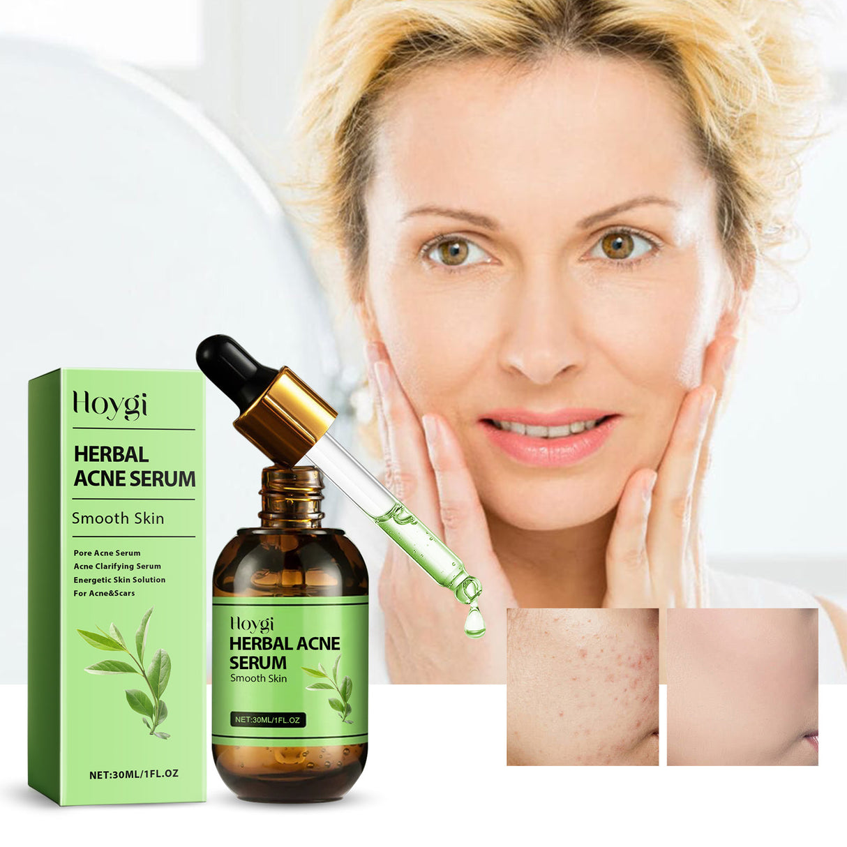 Herbal Acne Serum, Reduce Acne Pimples With A Comprehensive Moisturizing Moisturizer - V.I.P Digital Presence