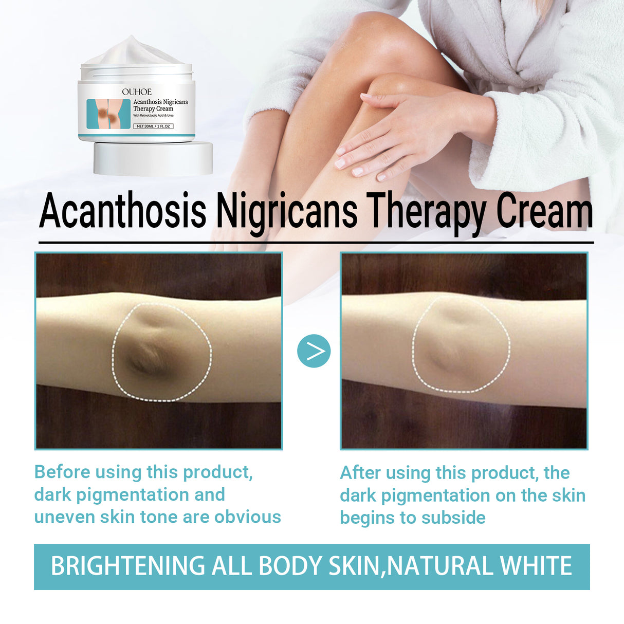 Acanthosis Nigricans Therapy Cream, Repair Dull Skin Lightening Joint Black Moisturizing Whitening Skin Care Cream - V.I.P Digital Presence