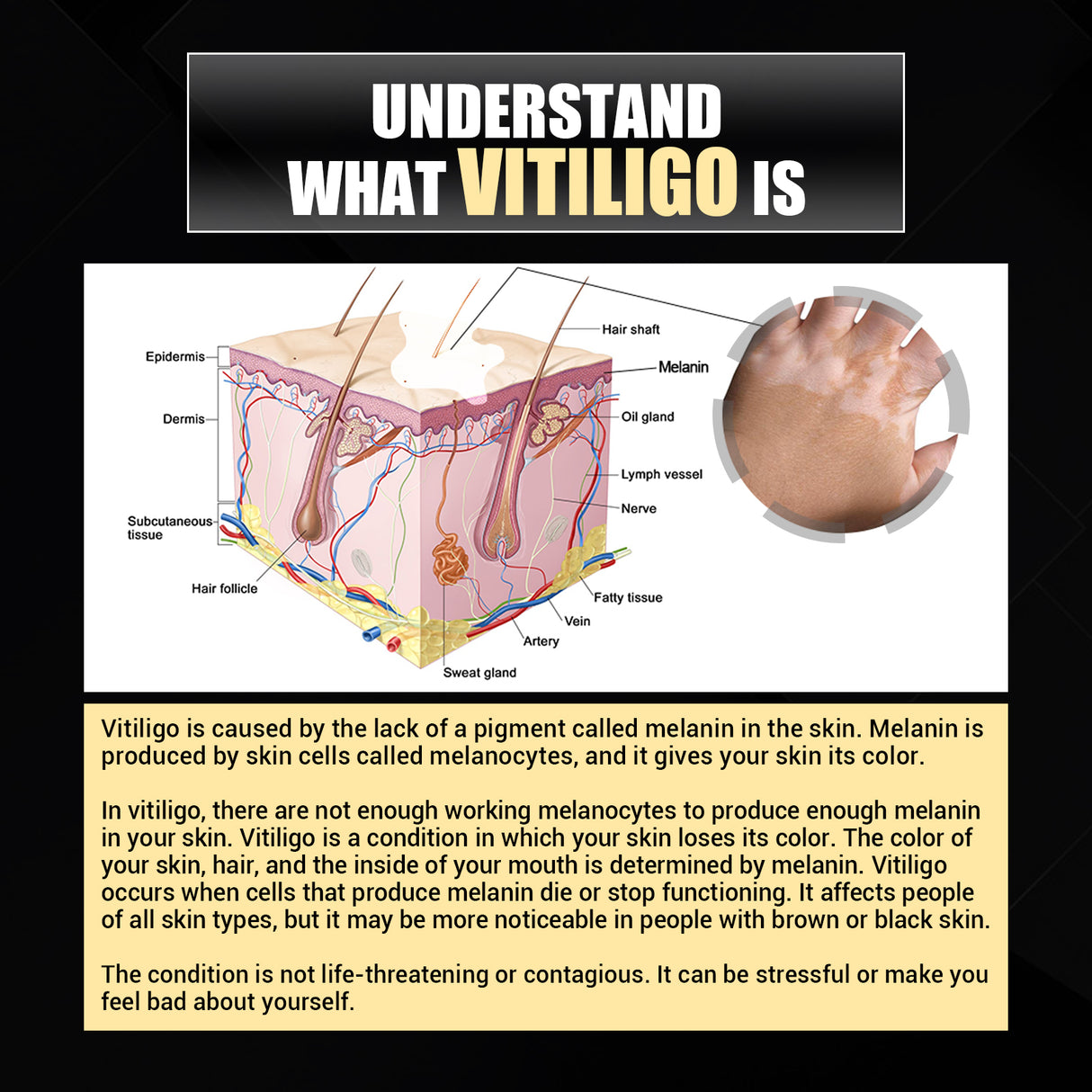 Vitiligo Removal Relief Spray, Repair Whitening Spot Perspiration Beauty Moisturizing Skin Care spray - V.I.P Digital Presence