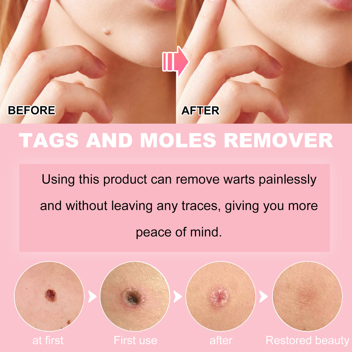 Skin Wart Lotion, Cleanses Skin And Removes Flat Eye Wart Lotion Especially Hand Cocoon - V.I.P Digital Presence