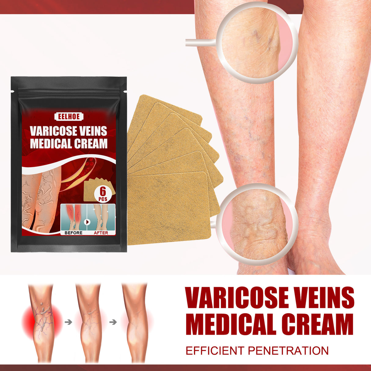 Aricose Veins Medical Cream, Relieve Leg Swelling Earthworm Leg Vein Massage To Relieve Pain - V.I.P Digital Presence