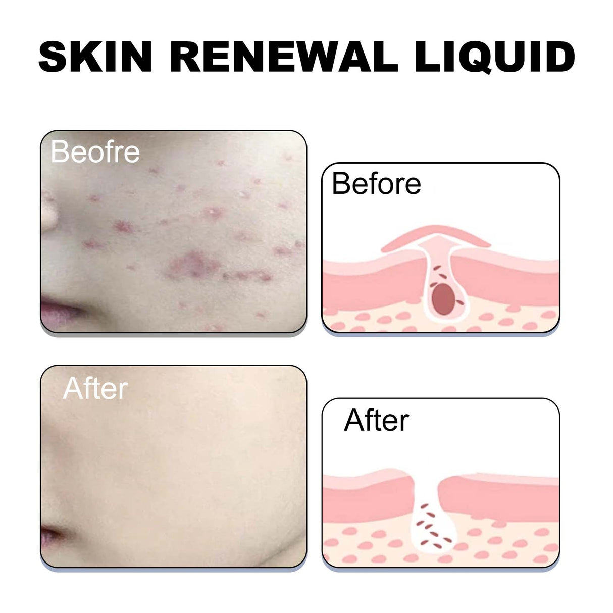 Skin Renewal Liquid, Reduce Acne Print Repair Acne Muscle Mild Clear Acne Hydrating Essence - V.I.P Digital Presence