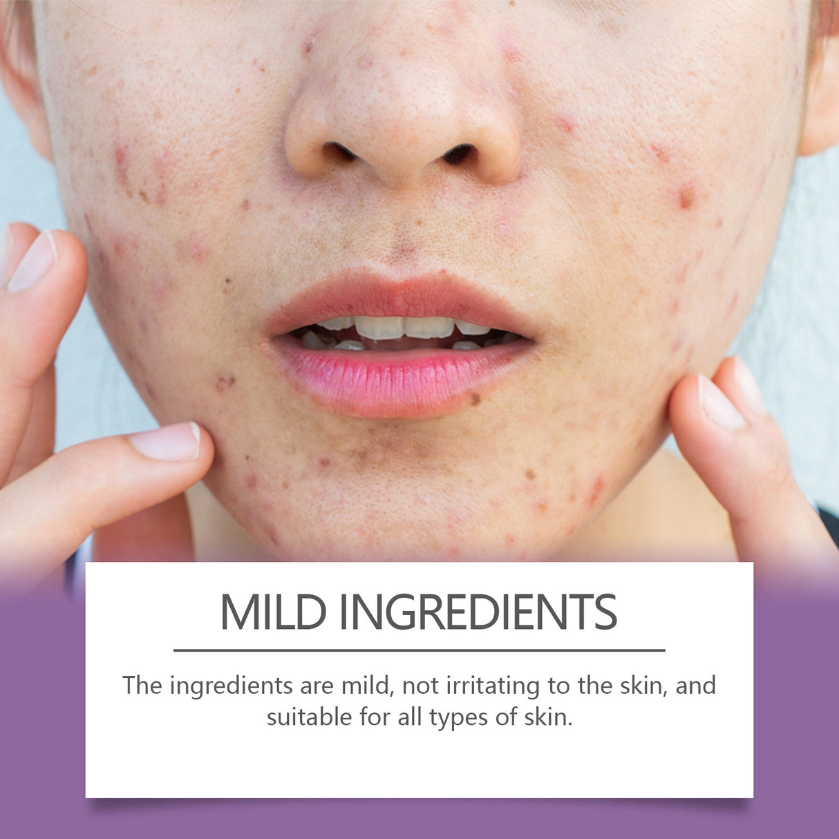 Multicolor Invisible Acne Patch Clear Acne Remove Acne Skin Care Facial Cover Acne Marks