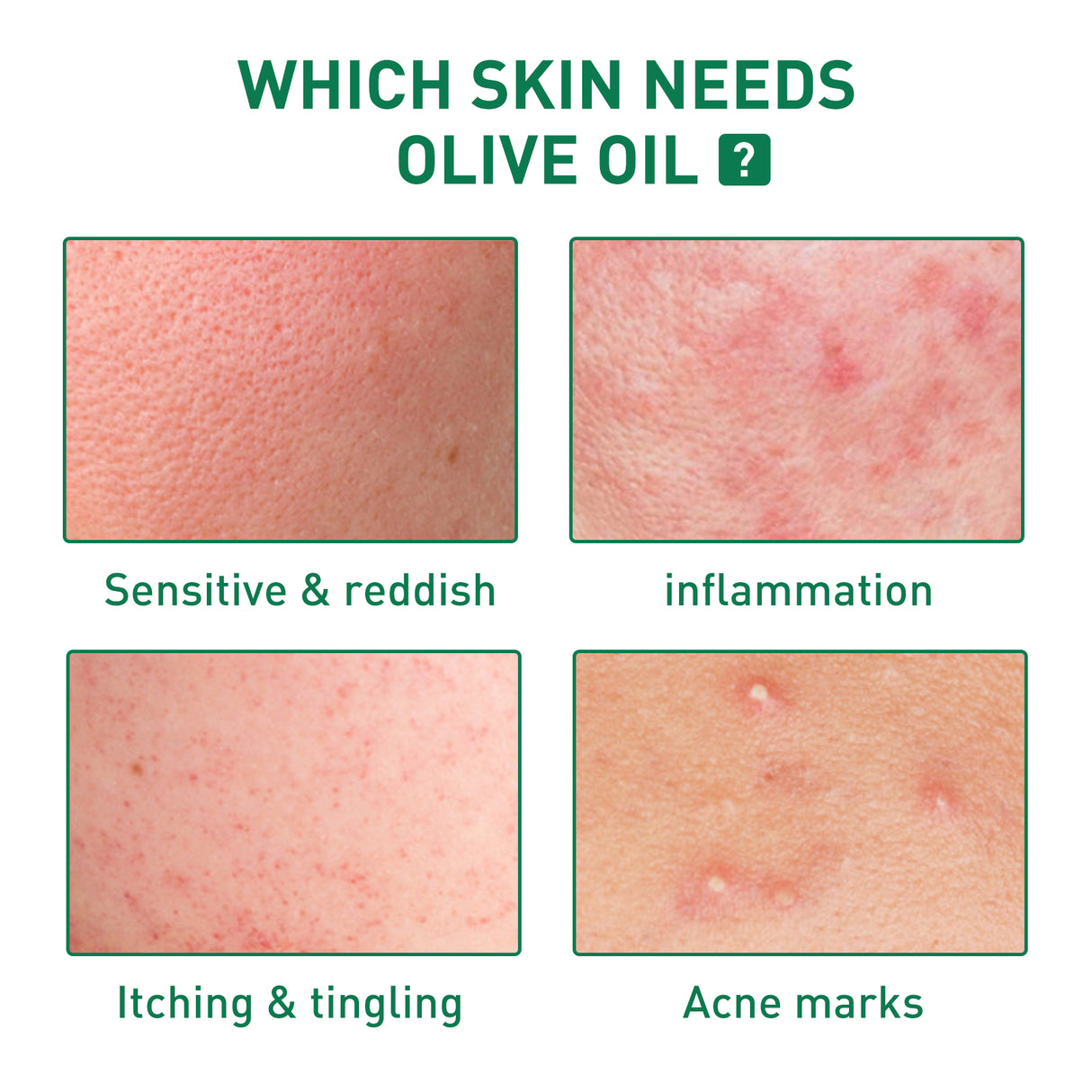 Tea Tree Oil Acne Serum, Remove Acne, Clear Acne, Repair Skin, Lighten Acne Printing Face Essence - V.I.P Digital Presence