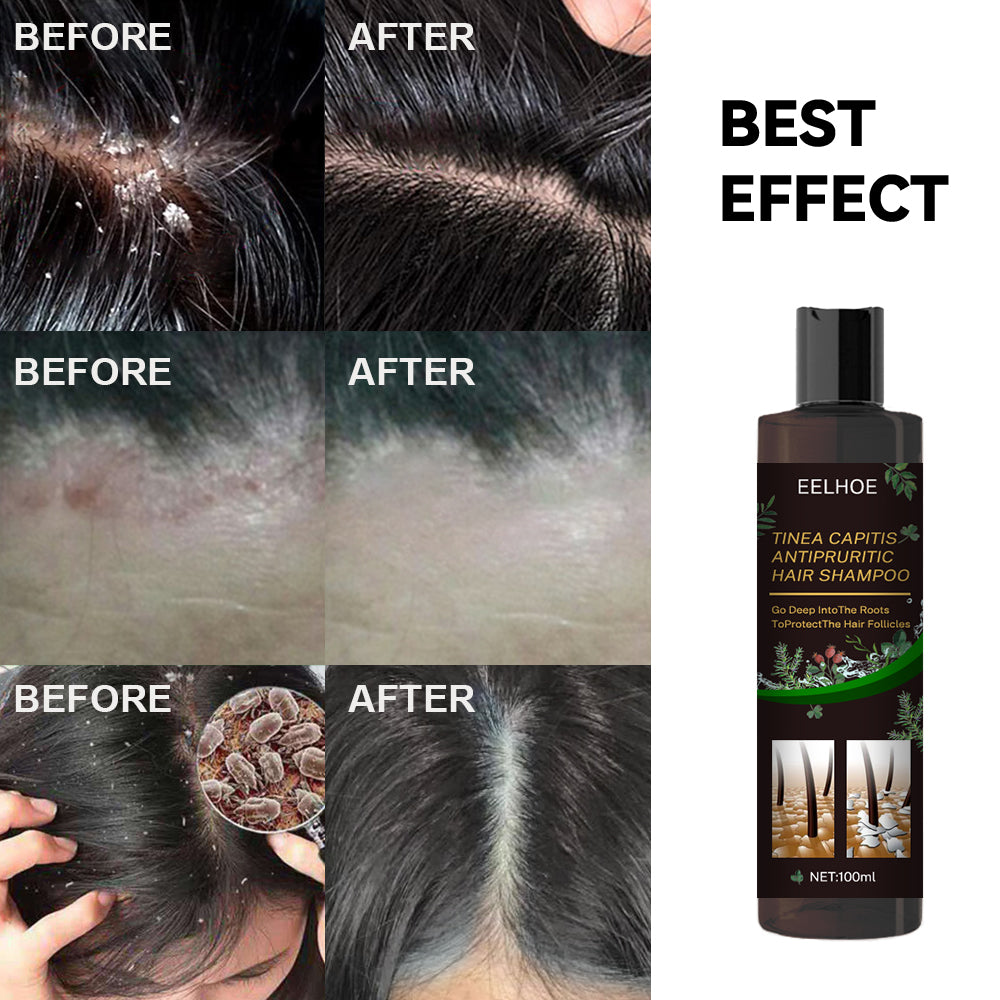 Tinea Capitis Anti-Itch Shampoo Anti-Drop Refreshing Oil Control Hair Care Anti-Dandruff Anti-Itch Shampoo - V.I.P Digital Presence