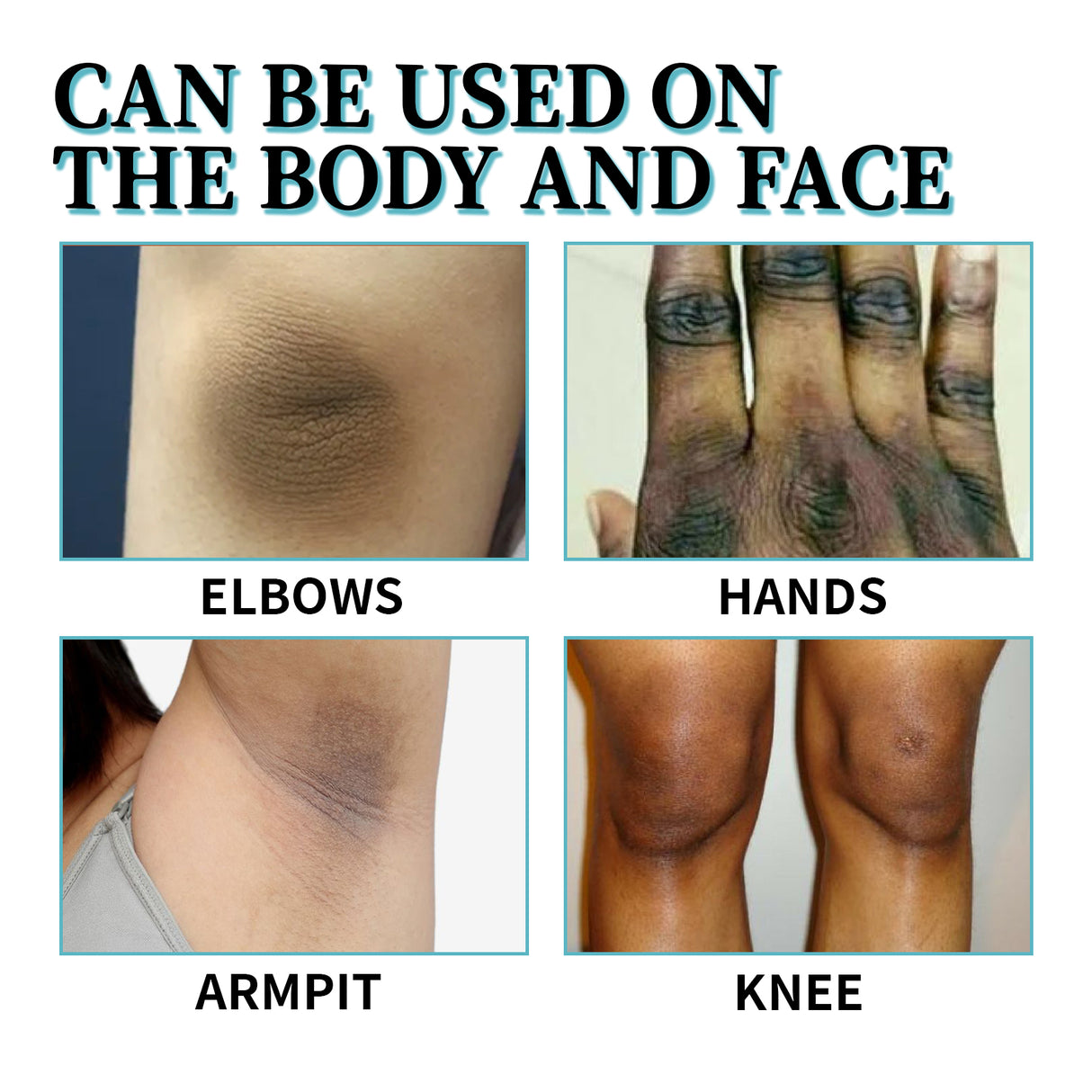 Acanthosis Nigricans Therapy Cream, Repair Dull Skin Lightening Joint Black Moisturizing Whitening Skin Care Cream - V.I.P Digital Presence