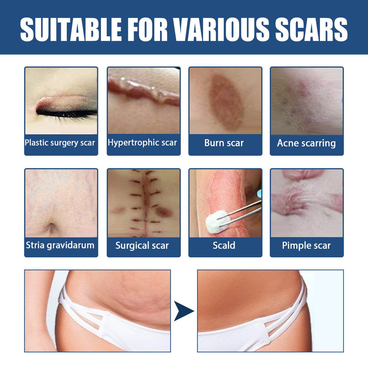 Scar Balm, Surgery Scar Repair Cold Compress Scar Skin Scar Gel Balm - V.I.P Digital Presence