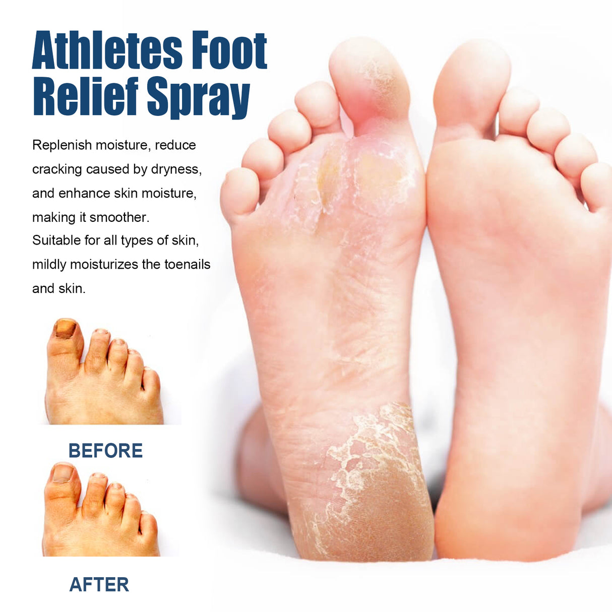 Athletes Foot Relief Spray, Relieve Foot Sweat Foot Itching Peeling Gray Nails Foot Odor Moisturizing Care Spray - V.I.P Digital Presence