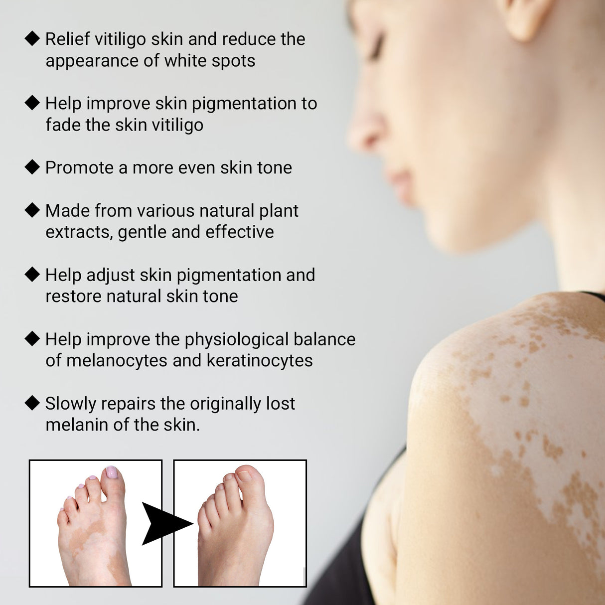 Vitiligo Removal Relief Spray, Repair Whitening Spot Perspiration Beauty Moisturizing Skin Care spray - V.I.P Digital Presence