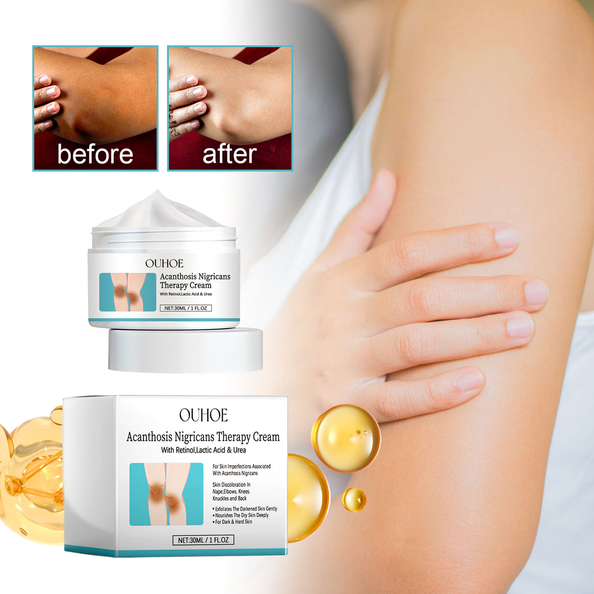 Acanthosis Nigricans Therapy Cream, Repair Dull Skin Lightening Joint Black Moisturizing Whitening Skin Care Cream - V.I.P Digital Presence