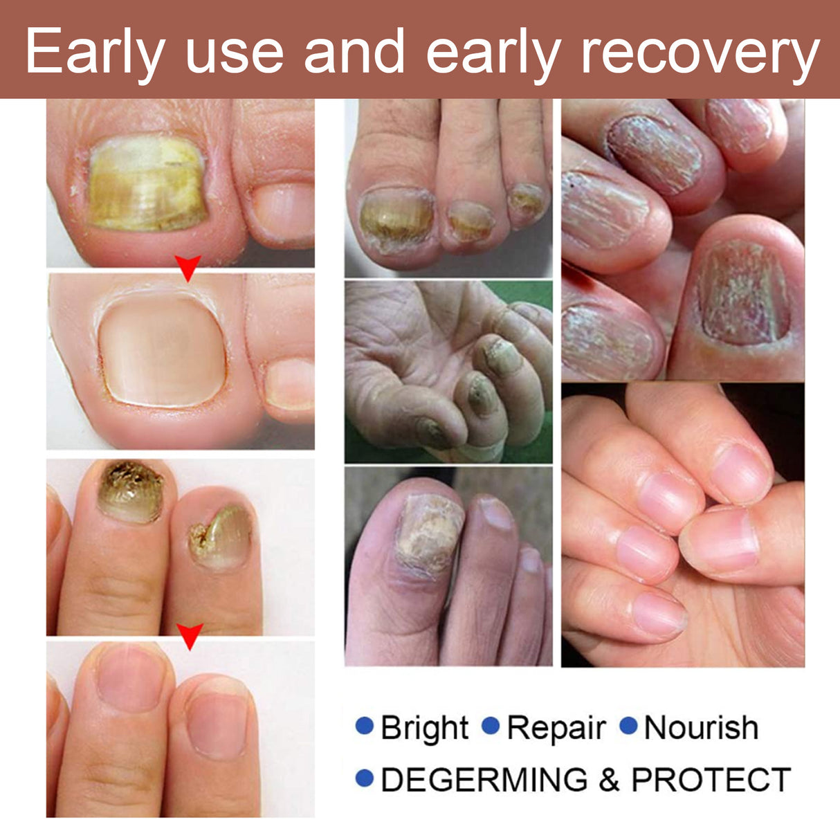 Herbal Antibacterial Nail Treatments Essential Oil, Grey Nail Care Essential Oil Brightening Nail Polish Clean Manicure Foot Care Solution - V.I.P Digital Presence