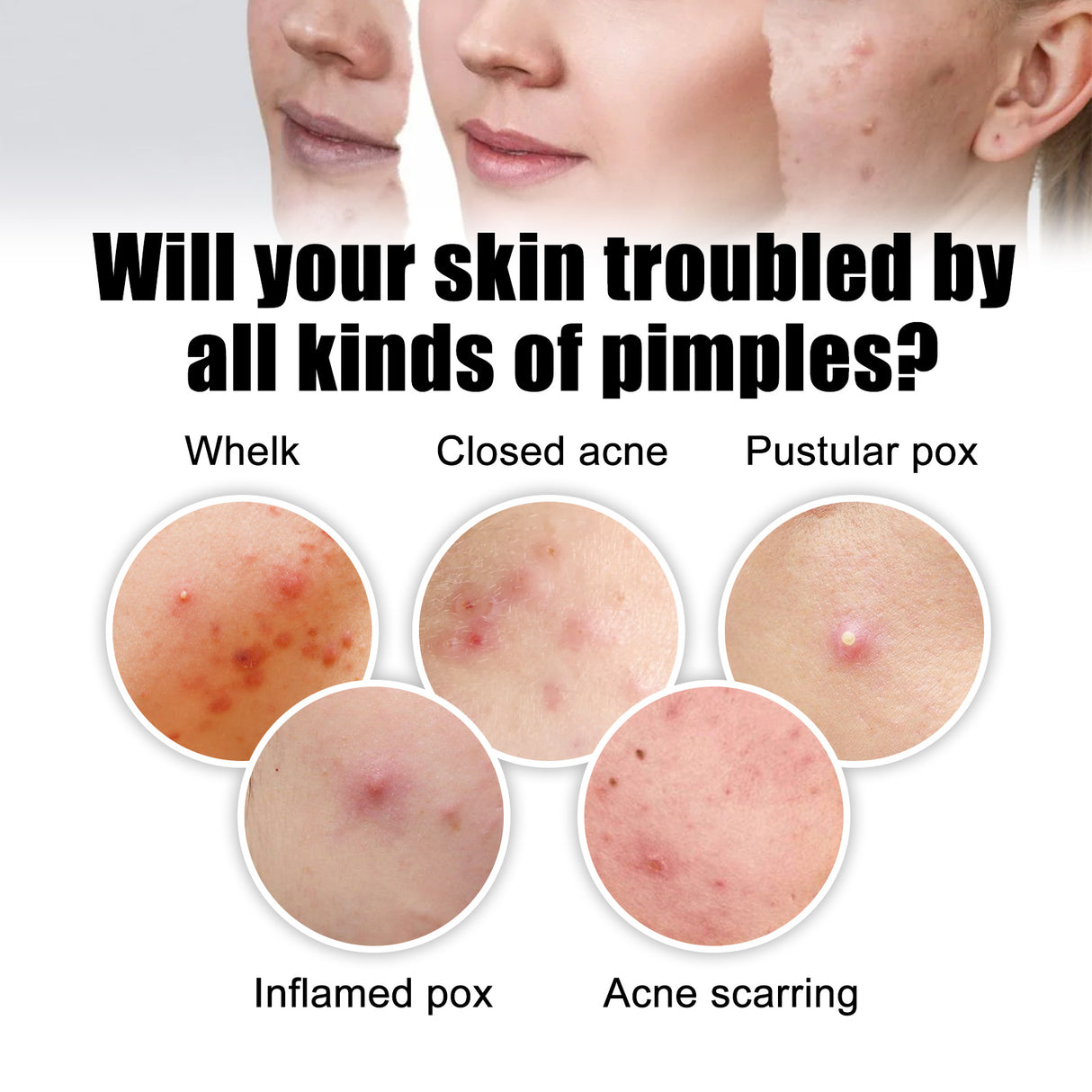 Acne Removal Protection Defense Patch, Color Profile-shaped Portable Invisible Cover Acne Patch - V.I.P Digital Presence