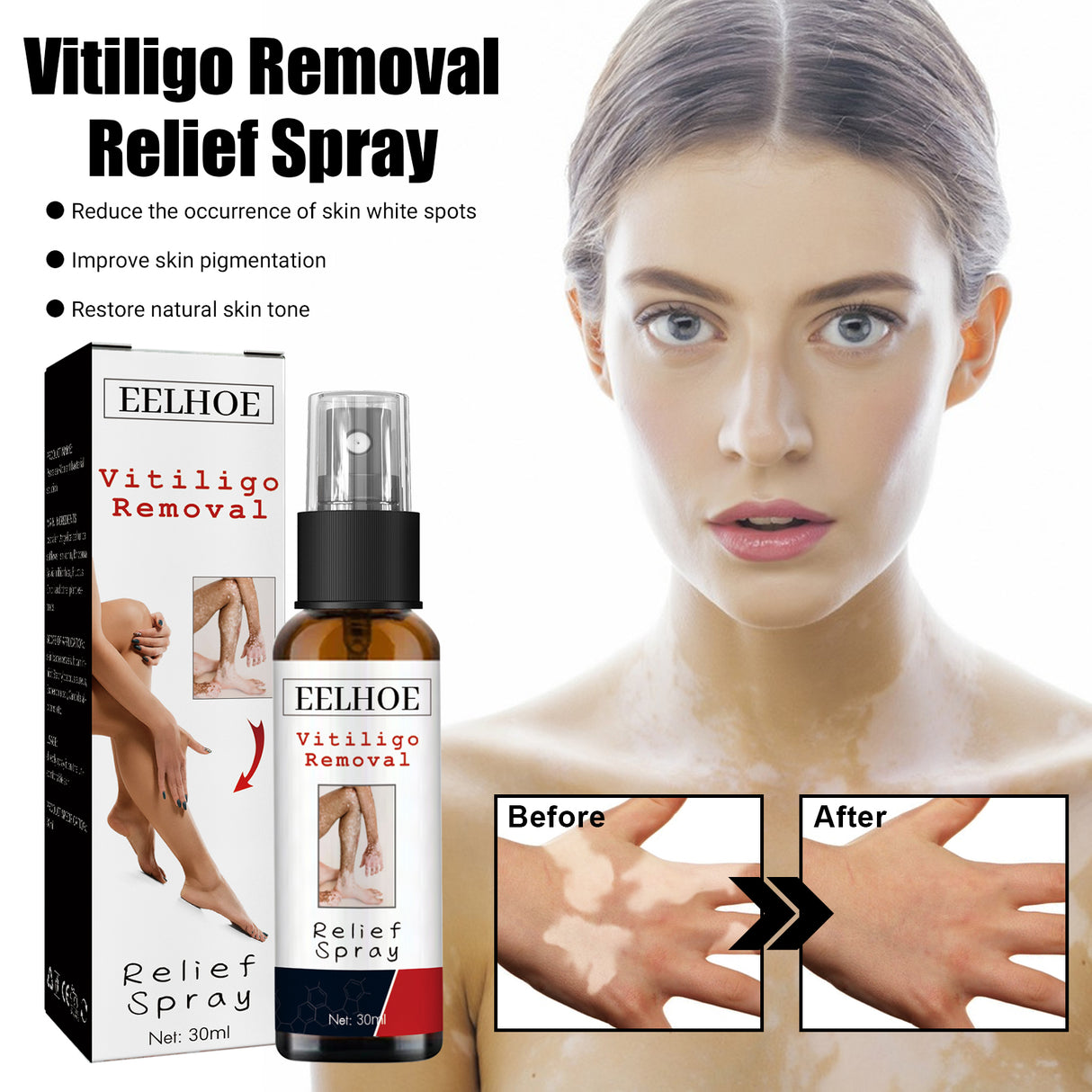 Vitiligo Removal Relief Spray, Repair Whitening Spot Perspiration Beauty Moisturizing Skin Care spray - V.I.P Digital Presence