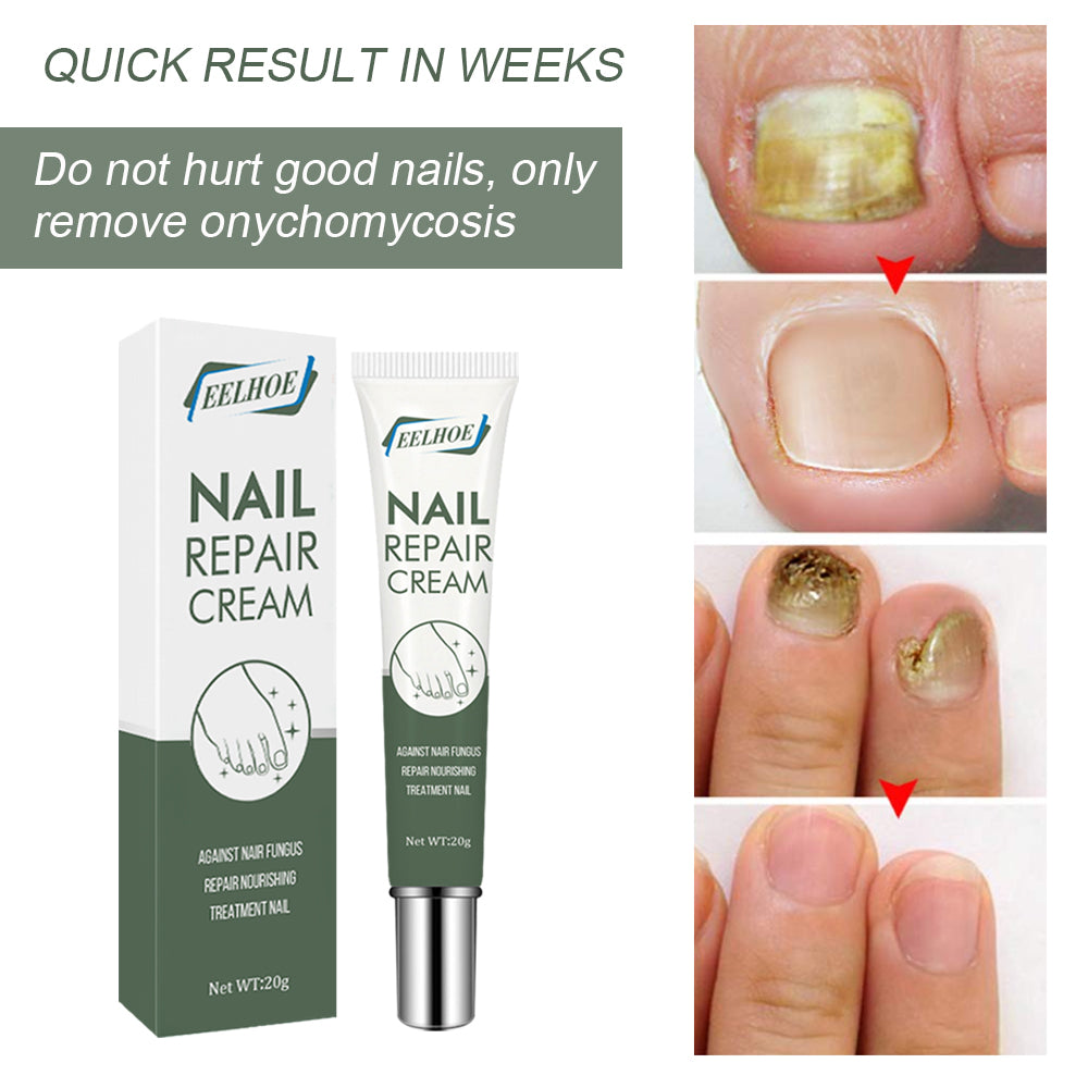Foot Care And Thickening Nail Repair Cream. Nail Repair Cream - V.I.P Digital Presence