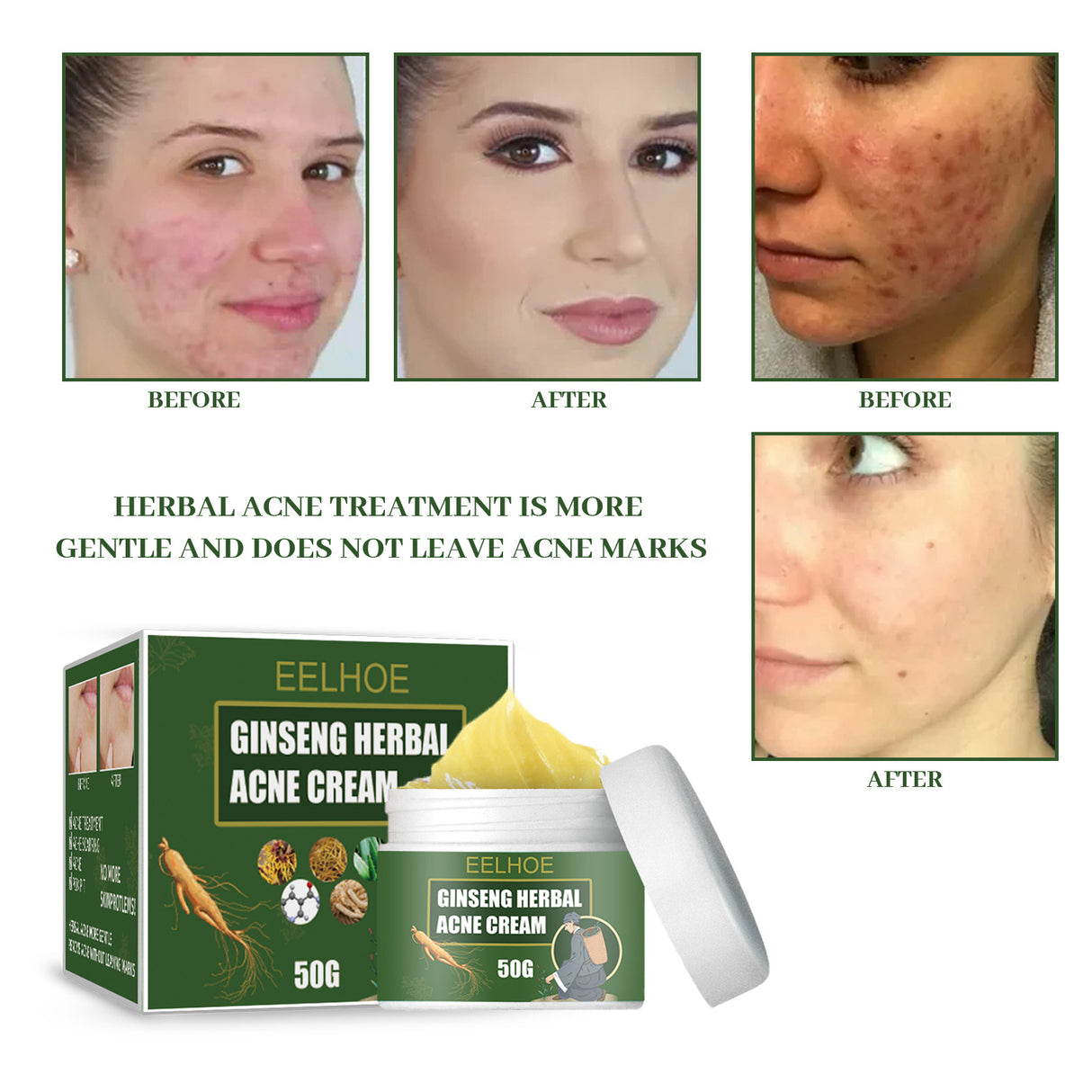 Herbal Acne-Removing Cream Anti-acne-Removing Cream Moisturizing Cleansing Cream Water Oil Balance Anti-acne-Removing Cream - V.I.P Digital Presence