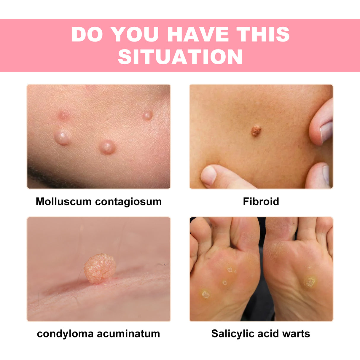 Skin Wart Lotion, Cleanses Skin And Removes Flat Eye Wart Lotion Especially Hand Cocoon - V.I.P Digital Presence