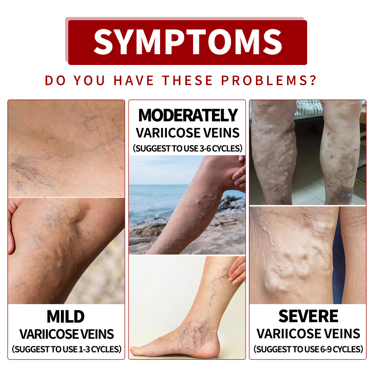 Venous Massage Varicose Cream, Relieves Bulging Leg Blood Vessels And Swollen Leg Earthworm Venous Massage Cream - V.I.P Digital Presence