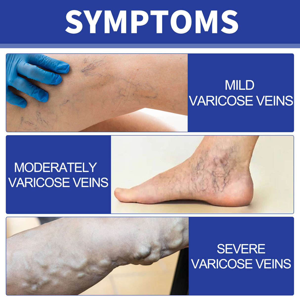 Vein Comfort Spray, Relief Leg Muscle Soreness And Swelling Earthworm Leg Vein Treatment Spray - V.I.P Digital Presence