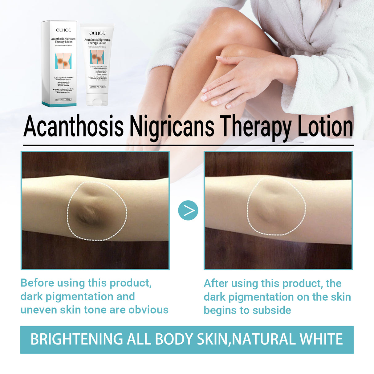 Acanthosis Nigricans Therapy Lotion, Skin Moisturizing Clean Black Dark Heavy Alar Knee Joint Repair Carry Bright Color Of Skin - V.I.P Digital Presence