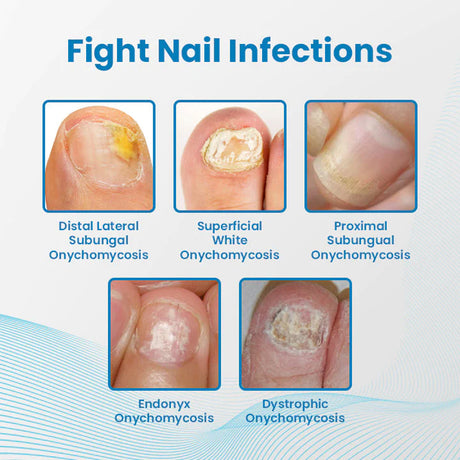 Anti-Paronychia Nail Repairing Gel, Repair Encased Rotten Nails Soft Nails Thickening Pain Relief Cleansing Care - V.I.P Digital Presence