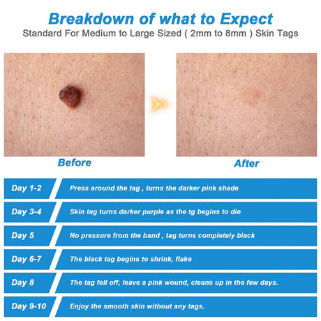 Auto Skin Tag Remover Kit Safe Painless Wart Acne Nodule Mole Corns Removal Pen Facial Cleaning Care Products Dropshipping - V.I.P Digital Presence