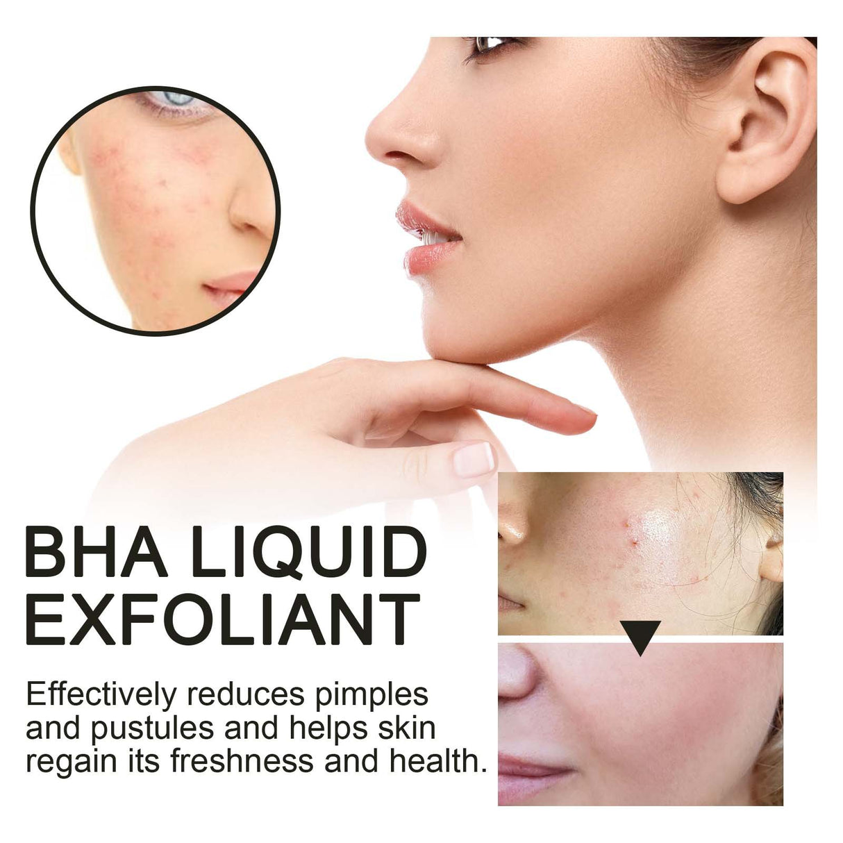 BHA Liquid Exfoliant, Lightening Acne Seal Pore-Tightening And Moisturizing Skin Essence - V.I.P Digital Presence