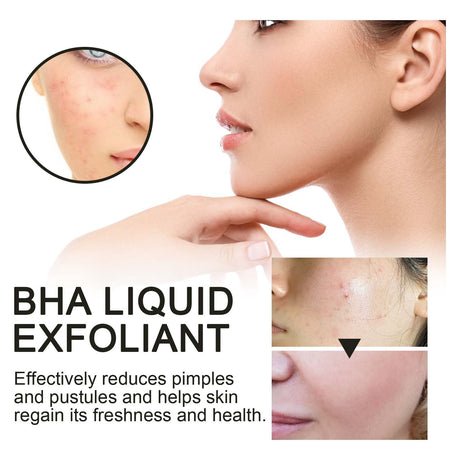 BHA Liquid Exfoliant, Lightening Acne Seal Pore-Tightening And Moisturizing Skin Essence - V.I.P Digital Presence