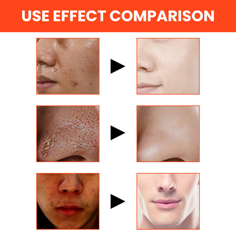 Men's Volcanic Face Wash, Acne Blackhead Face Deep Clean Pores And Oil Control - V.I.P Digital Presence