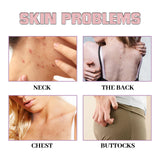 Acne Acne Ball, And Cleansing Skin Chest Back Acne Closing Skin Care - V.I.P Digital Presence
