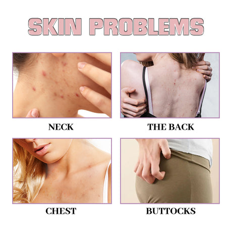 Acne Acne Ball, And Cleansing Skin Chest Back Acne Closing Skin Care - V.I.P Digital Presence