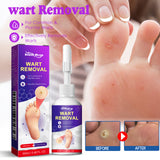 Remove Chicken Eye Lotion Extra Clear Remove Corns Skin Care Chicken Calluses Foot Pad Gram Warts - V.I.P Digital Presence