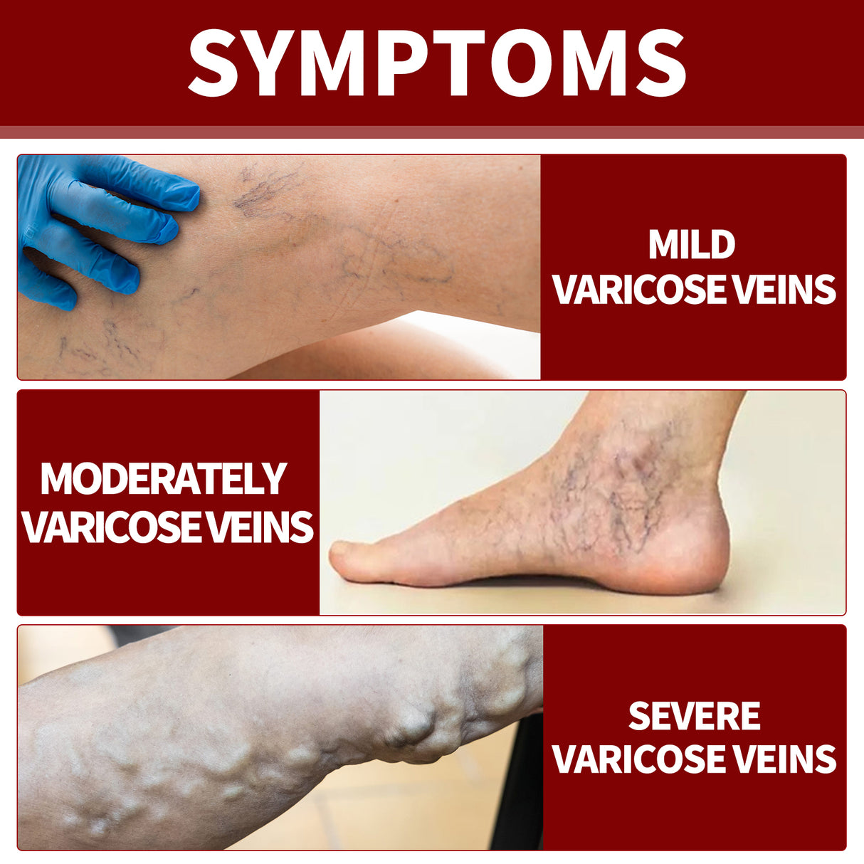 Veinmist Varicose Spray, Relief Sore Legs Massage Earthworm Leg Vein Treatment Spray - V.I.P Digital Presence