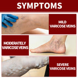 Veinmist Varicose Spray, Relief Sore Legs Massage Earthworm Leg Vein Treatment Spray - V.I.P Digital Presence