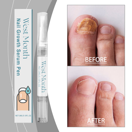 Nail Care Essence Pen, Fingernail Edge Soft Moisturizing Nail Surface Moisturizing And Nourishing Pen - V.I.P Digital Presence