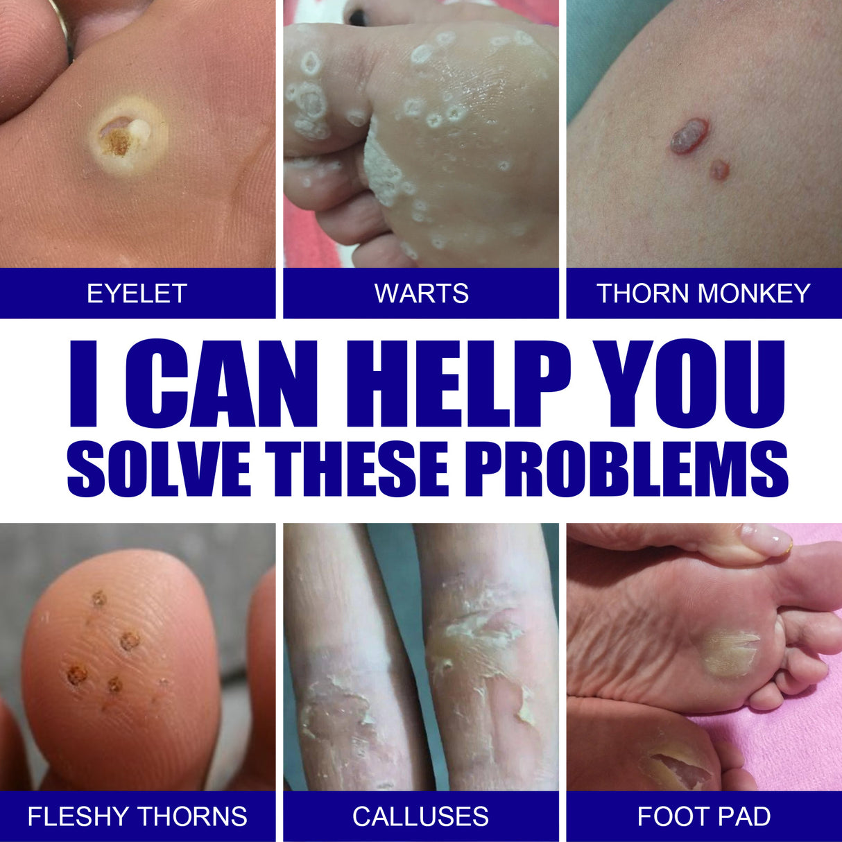 Wart Remover Ointment, Remove Hou Warts Flat Corn Plaster Flat Grains Warts, Foot And Repair Skin Dot Mole G Wart Cream - V.I.P Digital Presence