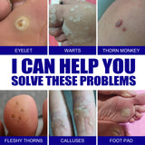 Wart Remover Ointment, Remove Hou Warts Flat Corn Plaster Flat Grains Warts, Foot And Repair Skin Dot Mole G Wart Cream - V.I.P Digital Presence