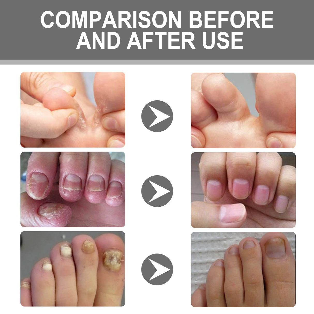 Nail Care Cream, Light Armor Repair Bad Ingrown Nail Nails Brothers Nail Thickening A Ditch Nursing - V.I.P Digital Presence