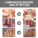 Nail Care Cream, Light Armor Repair Bad Ingrown Nail Nails Brothers Nail Thickening A Ditch Nursing - V.I.P Digital Presence