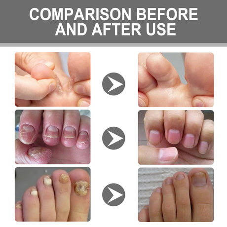 Nail Care Cream, Light Armor Repair Bad Ingrown Nail Nails Brothers Nail Thickening A Ditch Nursing - V.I.P Digital Presence