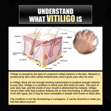 Vitiligo Removal Relief Spray, Repair Whitening Spot Perspiration Beauty Moisturizing Skin Care spray - V.I.P Digital Presence