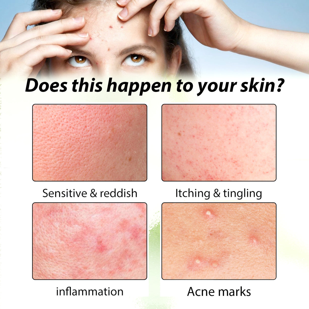 Herbal Acne Serum, Reduce Acne Pimples With A Comprehensive Moisturizing Moisturizer - V.I.P Digital Presence