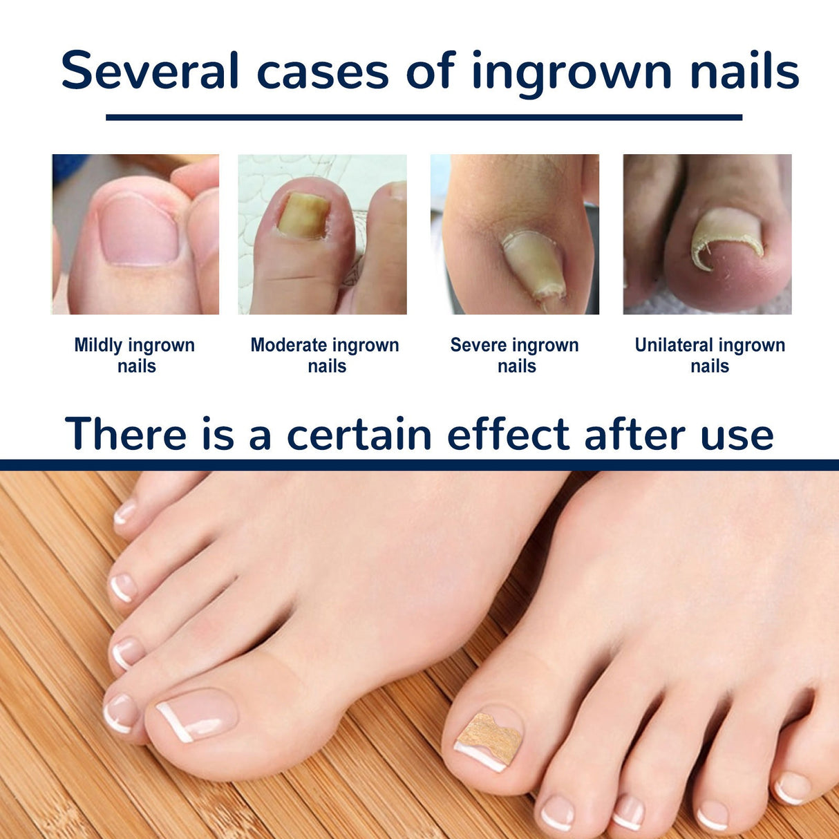 EELHOE toe nail correction patch - V.I.P Digital Presence