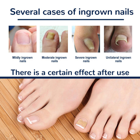 EELHOE toe nail correction patch - V.I.P Digital Presence