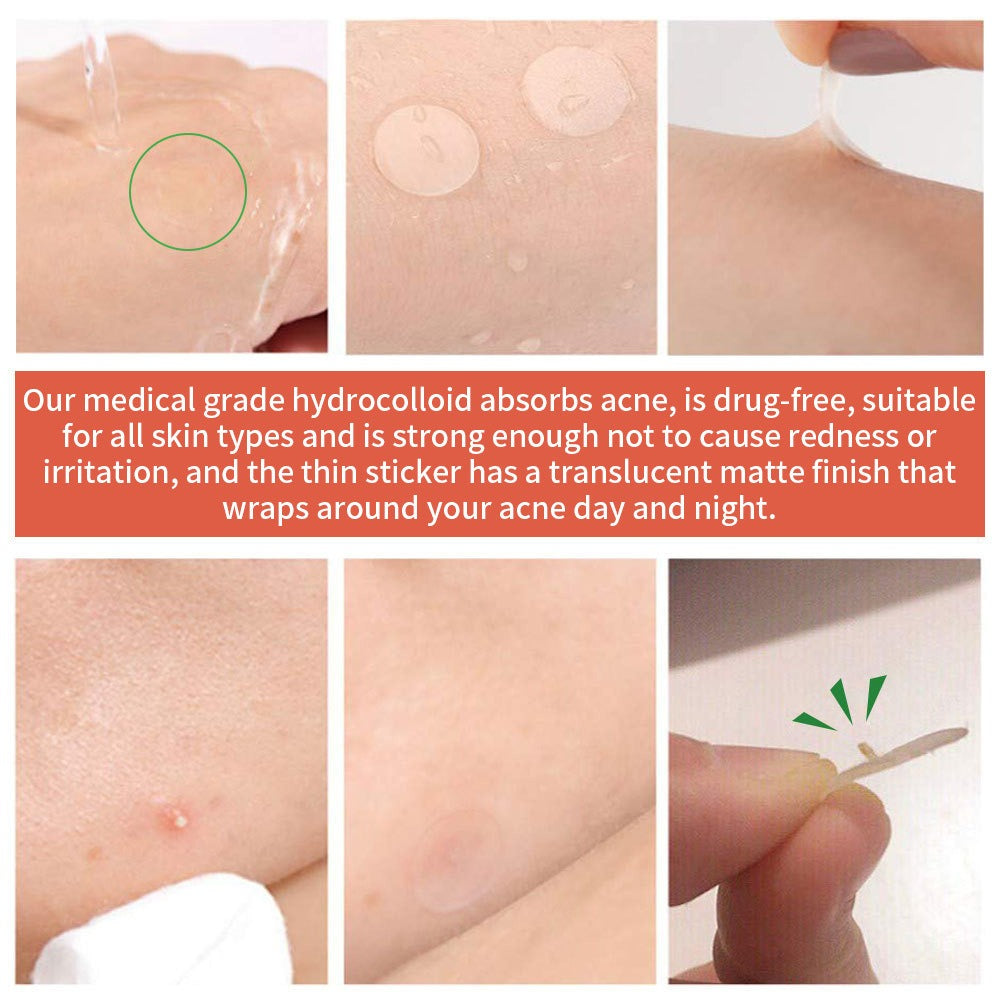 Youbuy invisible acne patch concealer acne patch acne remover without powder stuck acne patch 72 PATCHES - V.I.P Digital Presence