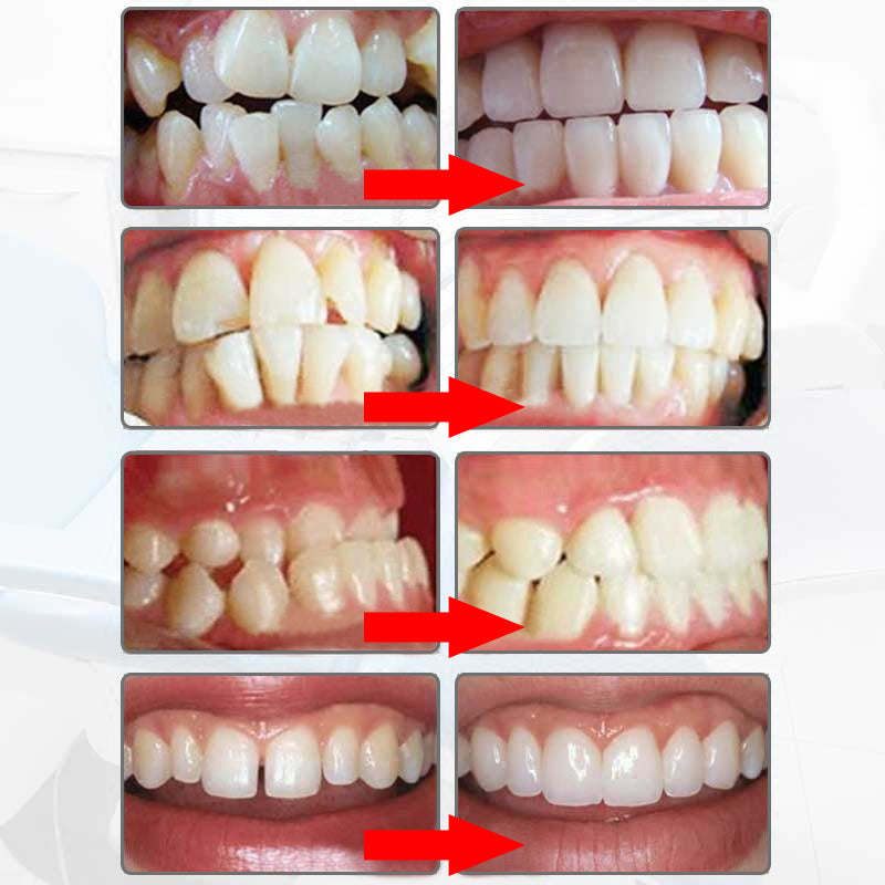 Adult Dental Tooth Orthodontics Dental Braces Teeth Whitening Dental Orthotics Tooth Alignment Tool Orthodontic Retainers - V.I.P Digital Presence
