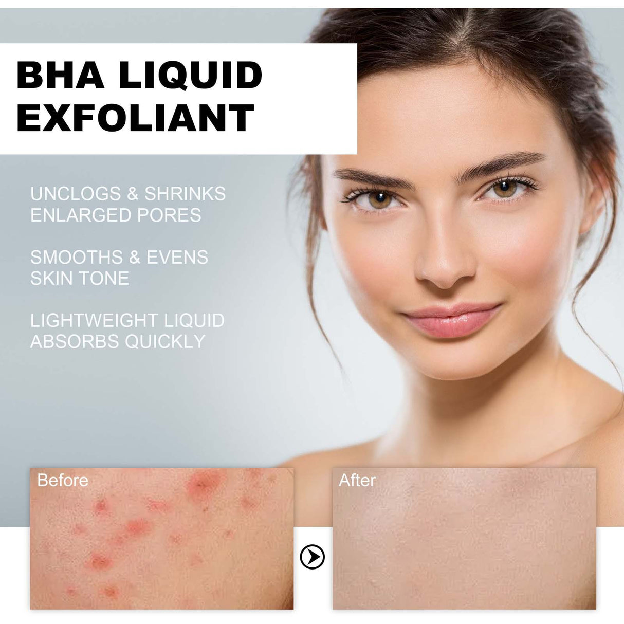 BHA Liquid Exfoliant, Lightening Acne Seal Pore-Tightening And Moisturizing Skin Essence - V.I.P Digital Presence