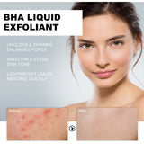 BHA Liquid Exfoliant, Lightening Acne Seal Pore-Tightening And Moisturizing Skin Essence - V.I.P Digital Presence