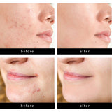 Youbuy invisible acne patch concealer acne patch acne remover without powder stuck acne patch 72 PATCHES - V.I.P Digital Presence